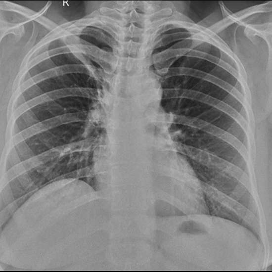 Chest X-Ray Lordotic view (chest axial view), Preparation, Procedure, and the Requirements
